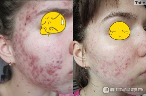 hieu qua cua gel tri mun immuno
