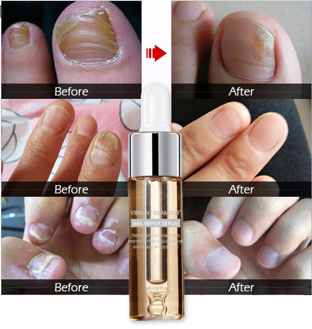 Nail Fungus Treatment Herb Nails Repair Cream Anti Infection Nail Foot Care  Onychomycosis Removal Essence Nail Protector Serum - Bộ chăm sóc móng |  