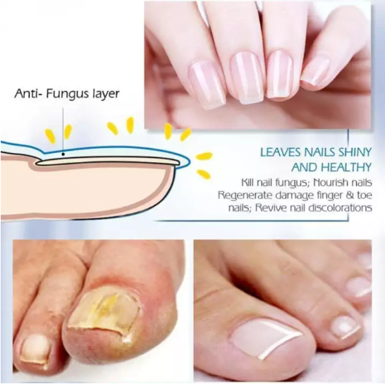 Nail Fungus Treatment Herb Nails Repair Cream Anti Infection Nail Foot Care  Onychomycosis Removal Essence Nail Protector Serum - Bộ chăm sóc móng |  