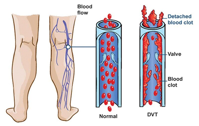 The Danger of DVT (Deep Vein Thrombosis)